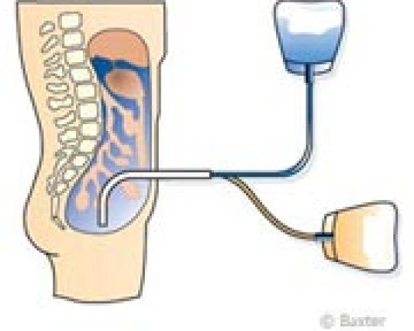 Peritoneale dialyse