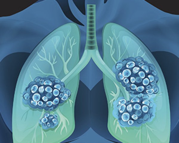 Deux types de cancer du poumon