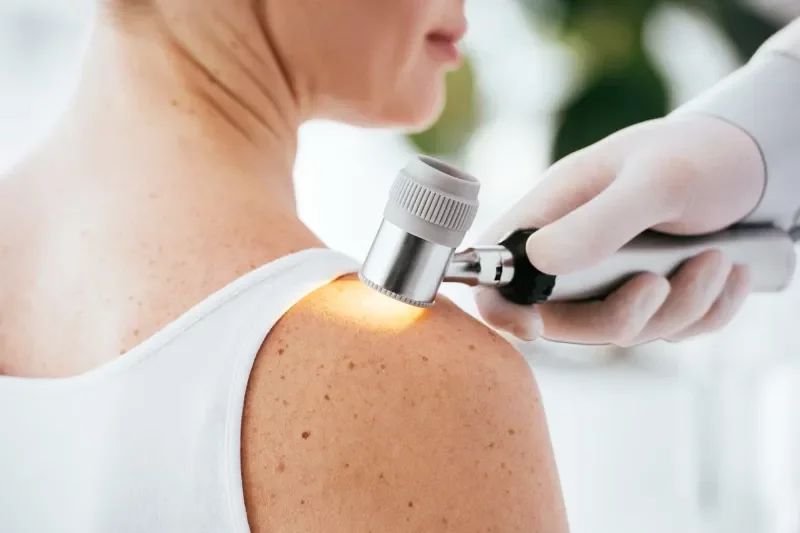 Een “intelligente tatoeage” om micro-melanomen te detecteren Een “intelligente tatoeage” om micro-melanomen te detecteren