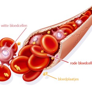 Chronische myeloïde leukemie