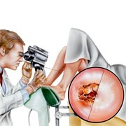 Cancer du col de l’utérus: quels traitements?