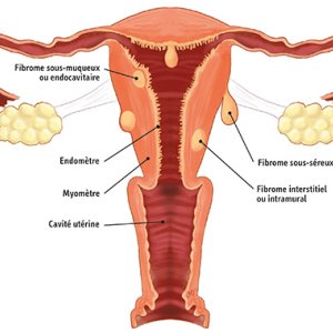 Baarmoederfibromen