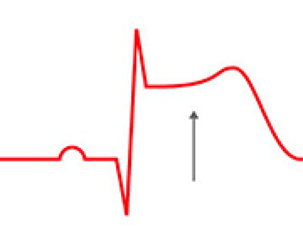 Het elektrocardiogram (ECG) om de diagnose van ACS te bevestigen