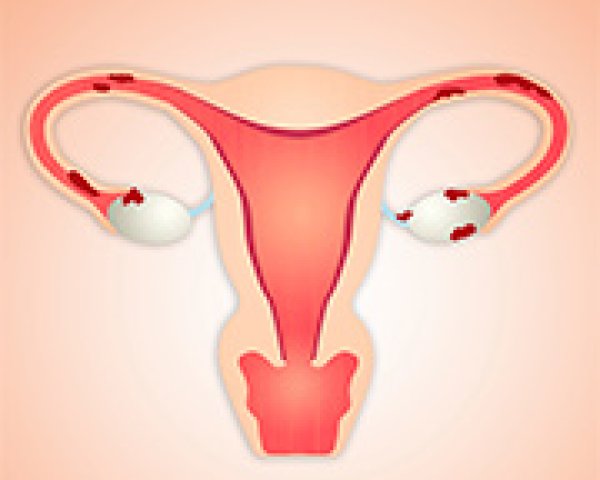 L’endométriose: cause possible d’infertilité