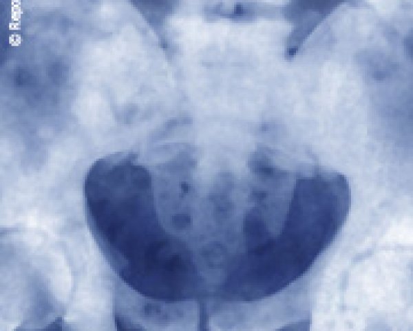 Comment diagnostiquer les métastases osseuses?