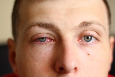 Conjunctivitis of oogbindvliesontsteking