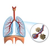 Les bronches, au centre de l’appareil respiratoire