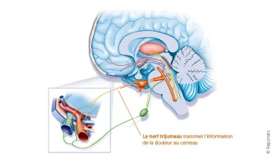 Qu’est-ce qu’une migraine?