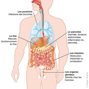 Mucoviscidose: aantasting van verschillende organen