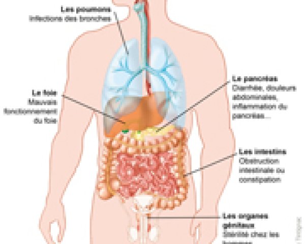 Mucoviscidose: aantasting van verschillende organen