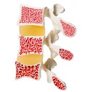 L'ostéodensitométrie pour diagnostiquer l'ostéoporose