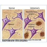 De ziekte van Alzheimer: een hersenaandoening