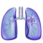 Qu'est-ce que le cancer du poumon?