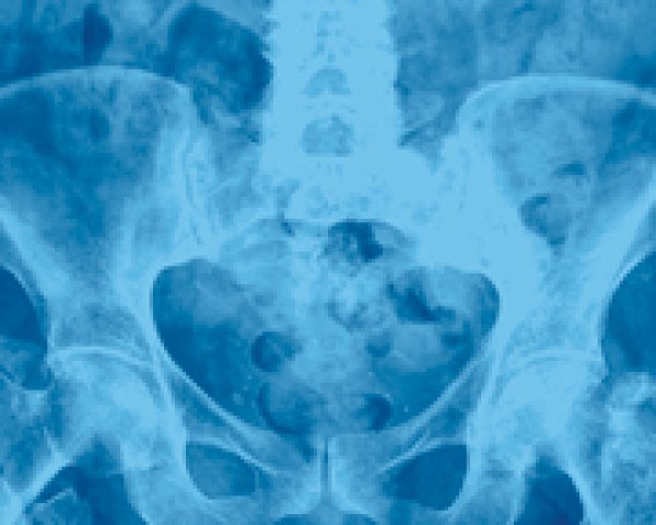 Ostéoporose - Radiographie: dans quels cas? | Medipedia