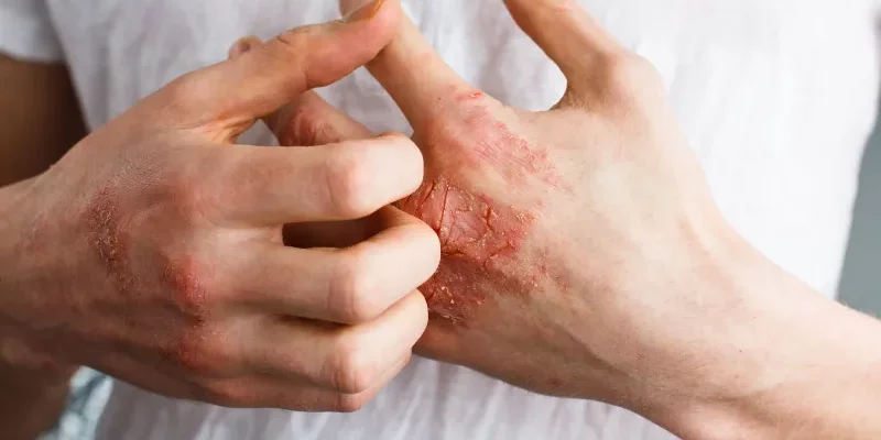 Chronisch eczeem van de handen, frequent en onderschat