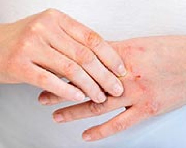 Les symptômes de la dermatite atopique