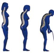 Les conséquences des fractures liées à l'ostéoporose