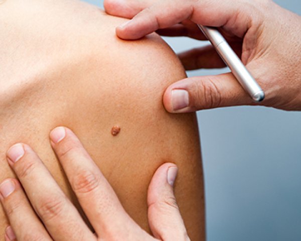Nacontrole na behandeling van melanoom