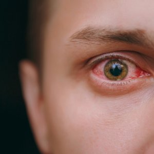 Oogontsteking, oogirritatie of droge ogen
