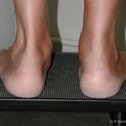 Insuffisance veineuse - Les jambes gonflées (œdèmes) | Medipedia